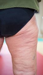 how to reduce cellulite in your legs